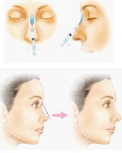 上海容妍国际整形医院鼻基底注射案例