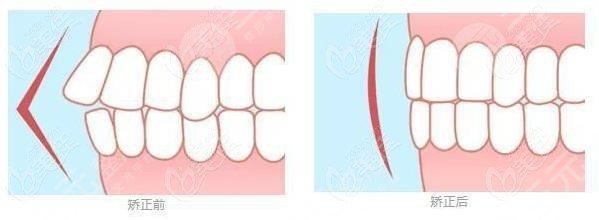 株洲家鸿口腔医院牙齿矫正案例