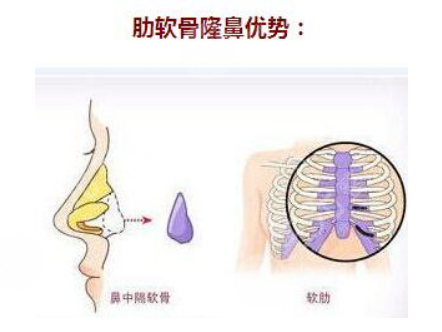 肋软骨隆鼻