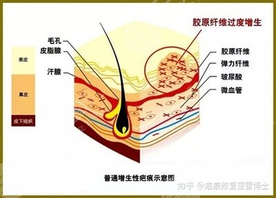 兰州军区总医院整形科去疤痕案例