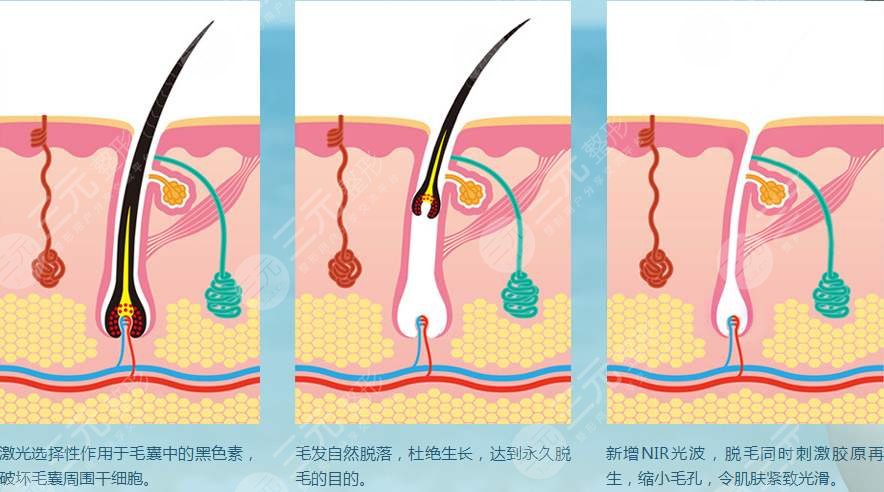 激光脱毛有哪些优势呢?