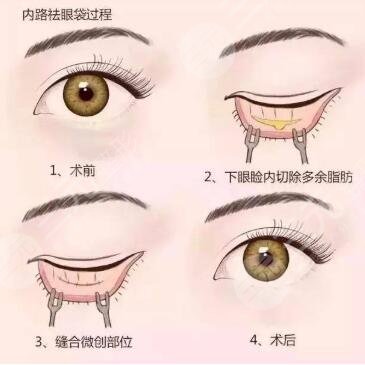 内切去眼袋手术之后应该怎么样护理呢