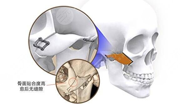 下颌角整形手术术前有哪些注意事项