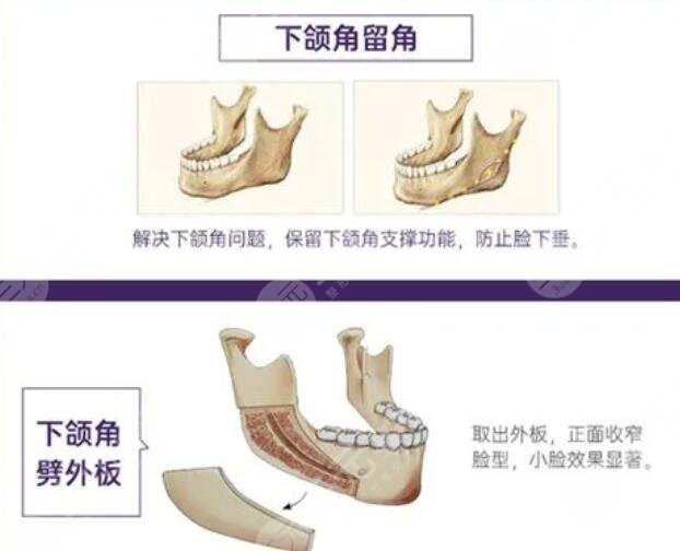 下颌角整形手术的过程