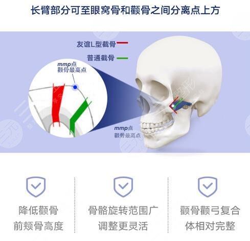 磨颧骨整形手术的恢复时间