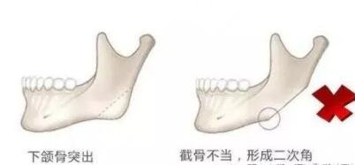 下颌角整形的手术优势是什么?