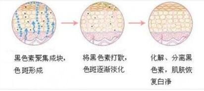 激光祛斑手术的疗程