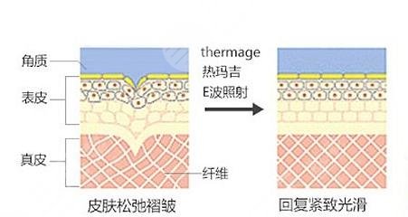 热玛吉除皱抗衰有副作用吗?