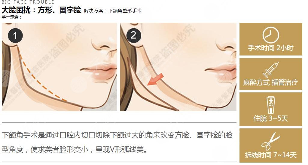 颧骨整形术手术操作流程是怎样的?