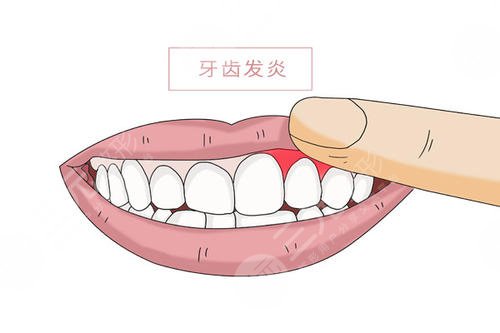 贵州中医药大学第二附属医院洗牙知识科普：洗牙好处、坏处