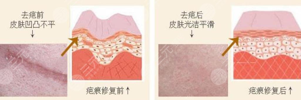 西安米兰柏羽医疗美容医院手术去痣科普问答