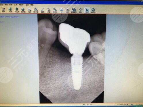 上海美奥口腔牙齿种植案例分享
