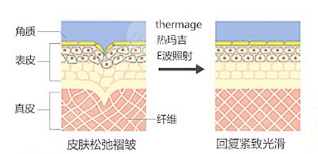 热玛吉除皱抗衰操作方式是什么?