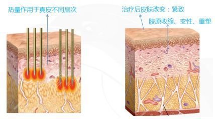 热玛吉除皱抗衰果能维持多久?