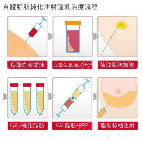 自体脂肪丰胸相关知识科普:自体脂肪隆胸贵吗?