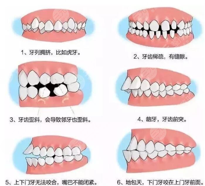 牙齿矫正的所以方式都有哪些区别