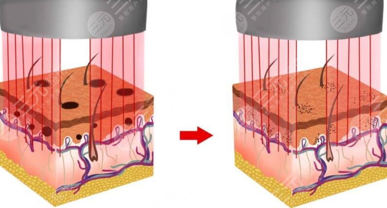 激光祛斑手术的原理