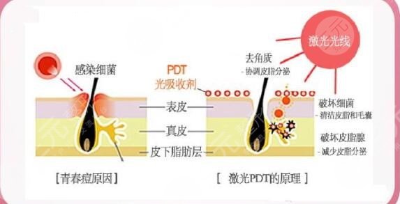 彩光祛痘操作流程是怎样的