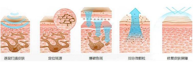 激光祛斑的主要果