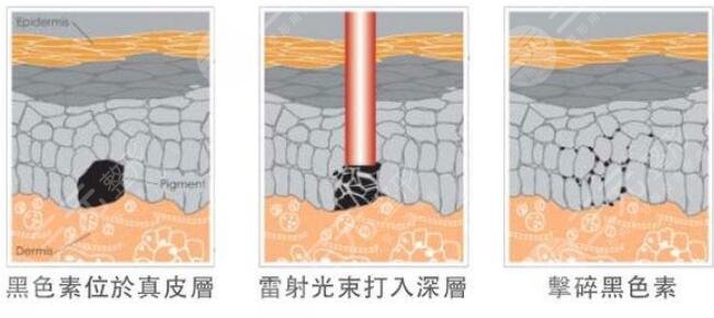 激光祛斑果好不好