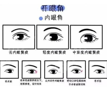 改善内眦赘皮