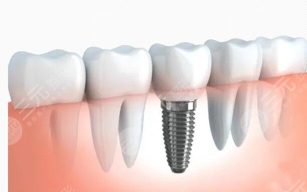 牙齿种植的原理是什么