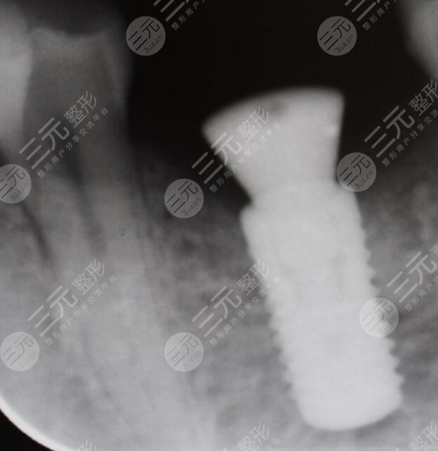 南京雅度口腔医院种植牙前x片