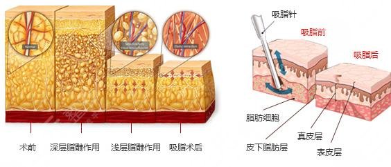 吸脂瘦小腿