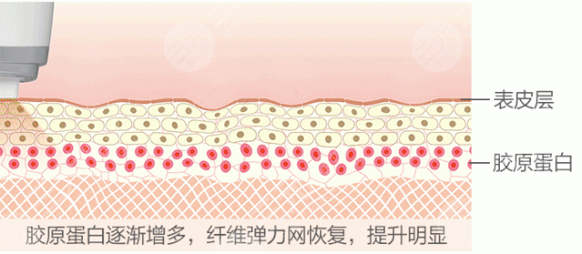 热玛吉的治疗原理是什么