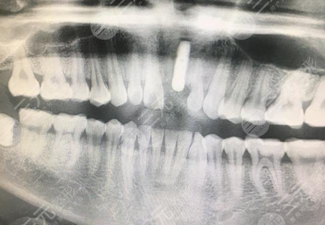 杭州西湖口腔医院种植牙经历过程分享