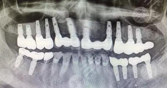 益阳口腔医院全口种植手术过程分享