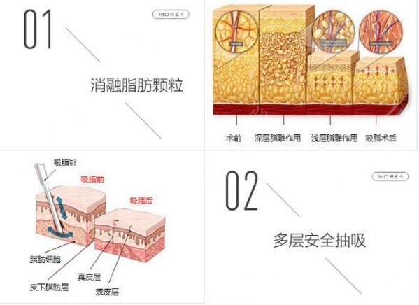 温州市和平整形医院科普抽脂手术