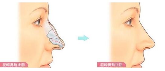 赣州市立医院烧伤整形科科普隆鼻手术知识