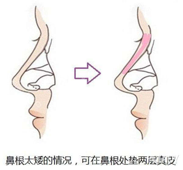 赣州市立医院烧伤整形科科普隆鼻手术知识