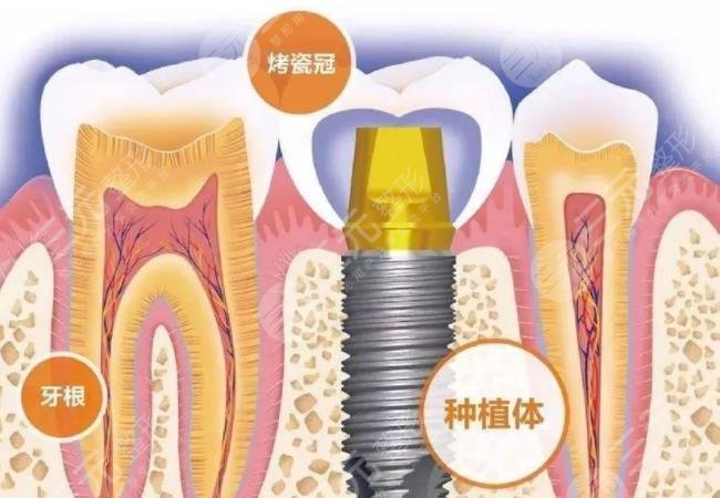 南宁牙百年口腔医院种植牙相关介绍