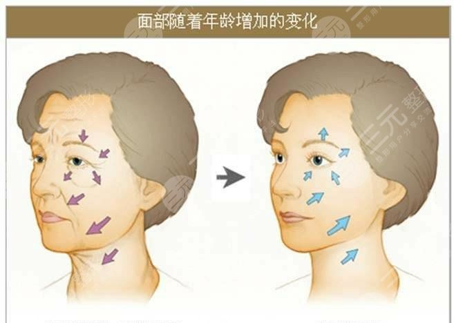 广州中医药大学金沙洲医院除皱后一个月