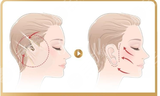 拉皮和小切口手术的区别