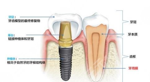 济南美奥口腔医院种植牙相关问答介绍