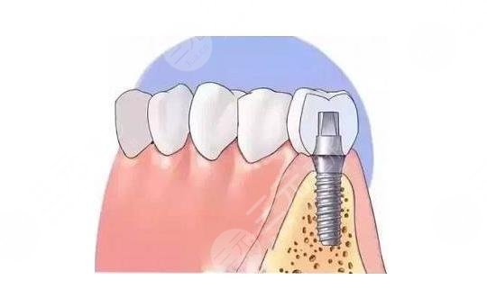 乌鲁木齐美奥口腔医院种植牙术后注意事项