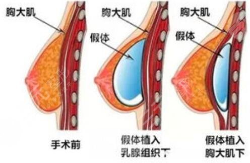 威海美神医疗美容科普假体隆胸是怎样做的