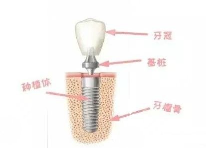 种植牙相关知识科普