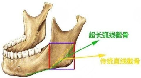 下颌角磨骨手术适合哪些人