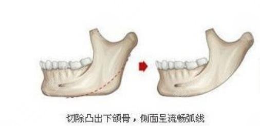 下颌角整形