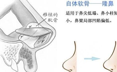 隆鼻手术