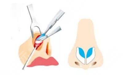 隆鼻手术