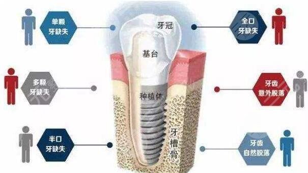 种植牙技术是怎么做的