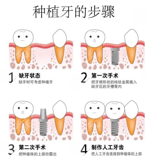 牙齿种植后需要忌口吗?