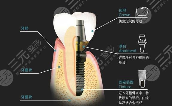 牙齿种植