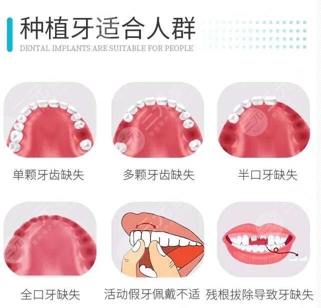 什么是牙齿种植