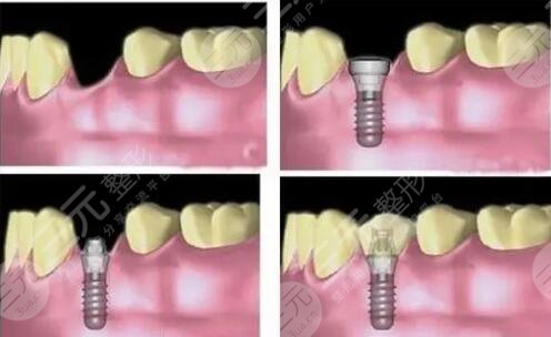 种植牙过程